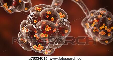 Stock Photography - Staphylococcal pneumonia. Computer illustration of Staphylococcus aureus bacteria inside the alveoli of the lungs, causing pneumonia.. Fotosearch