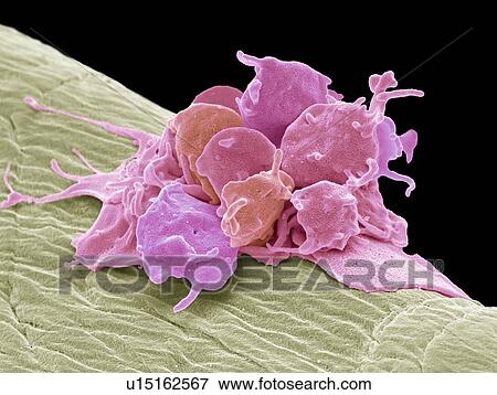 Stock Photo - Activated platelets. Coloured scanning electron micrograph (SEM) of activated platelets attached to surgical gauze. Platelets are tiny blood cells that help the body form clots to stop bleeding. If a blood vessels gets damaged, it sends out signals.... Fotosearch