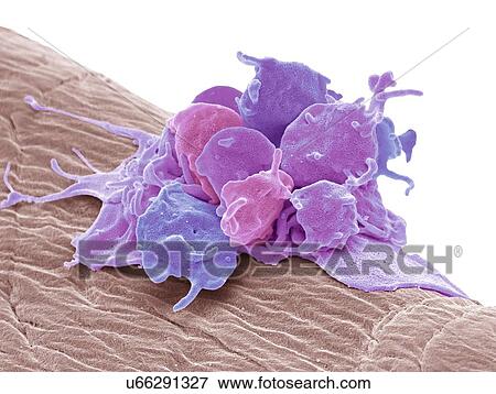 Activated platelets. Coloured scanning electron micrograph (SEM) of activated platelets attached to surgical gauze. Platelets are tiny blood cells that help the body form clots to stop bleeding. If a blood vessels gets damaged, it sends out signals... View Large Photo Image Stock Photo - Activated platelets. Coloured scanning electron micrograph (SEM) of activated platelets attached to surgical gauze. Platelets are tiny blood cells that help the body form clots to stop bleeding. If a blood vessels gets damaged, it sends out signals.... Fotosearch