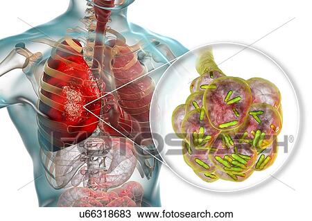 Stock Image - Bacterial pneumonia. Computer illustration of rod-shaped bacteria (bacilli) inside the alveoli of the lungs, causing a lower respiratory tract infection. This is more generally known as pneumonia, though that term can also be reserved for specific.... Fotosearch