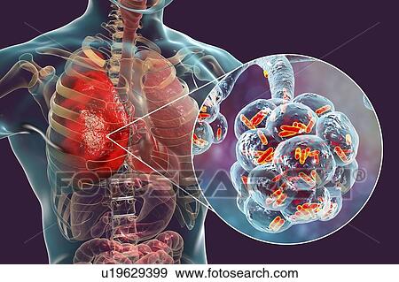 Stock Photo - Bacterial pneumonia. Computer illustration of rod-shaped bacteria (bacilli) inside the alveoli of the lungs, causing a lower respiratory tract infection. This is more generally known as pneumonia, though that term can also be reserved for specific.... Fotosearch