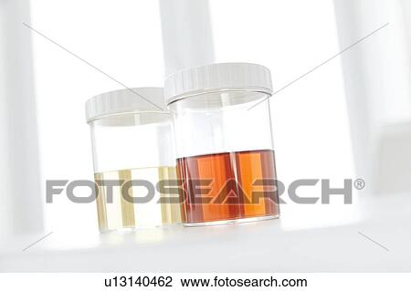 Blood in human urine in sample pot. View Large Photo Image Stock Image - Blood in human urine in sample pot.. Fotosearch