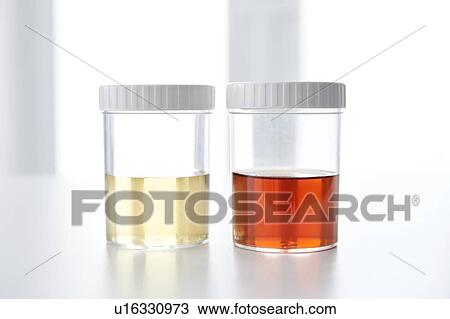 Stock Image - Blood in human urine in sample pot.. Fotosearch