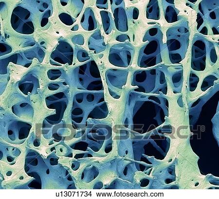 Picture - Bone tissue. Coloured scanning electron micrograph (SEM) of human cancellous (spongy) bone. Bone tissue can be either cortical (compact) or cancellous. Cortical bone usually makes up the exterior of the bone, while cancellous bone is found in the.... Fotosearch