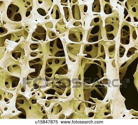 Bone tissue. Coloured scanning electron micrograph (SEM) of human cancellous (spongy) bone. Bone tissue can be either cortical (compact) or cancellous. Cortical bone usually makes up the exterior of the bone, while cancellous bone is found in the... View Large Photo Image Stock Photography - Bone tissue. Coloured scanning electron micrograph (SEM) of human cancellous (spongy) bone. Bone tissue can be either cortical (compact) or cancellous. Cortical bone usually makes up the exterior of the bone, while cancellous bone is found in the.... Fotosearch