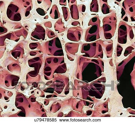 Bone tissue. Coloured scanning electron micrograph (SEM) of human cancellous (spongy) bone. Bone tissue can be either cortical (compact) or cancellous. Cortical bone usually makes up the exterior of the bone, while cancellous bone is found in the... View Large Photo Image Stock Photography - Bone tissue. Coloured scanning electron micrograph (SEM) of human cancellous (spongy) bone. Bone tissue can be either cortical (compact) or cancellous. Cortical bone usually makes up the exterior of the bone, while cancellous bone is found in the.... Fotosearch