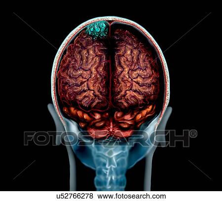 Stock Photo - Brain tumour (blue), magnetic resonance imaging (MRI) scan and illustration. This is a convexity meningioma in the parietal lobe of the brain. Meningiomas are cancers of the membranes (meninges) that line the brain. Convexity meningiomas are found on.... Fotosearch