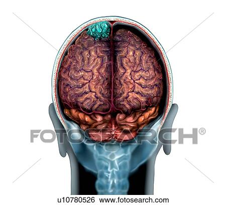 Brain tumour (blue), magnetic resonance imaging (MRI) scan and illustration. This is a convexity meningioma in the parietal lobe of the brain. Meningiomas are cancers of the membranes (meninges) that line the brain. Convexity meningiomas are found on... View Large Photo Image Stock Photograph - Brain tumour (blue), magnetic resonance imaging (MRI) scan and illustration. This is a convexity meningioma in the parietal lobe of the brain. Meningiomas are cancers of the membranes (meninges) that line the brain. Convexity meningiomas are found on.... Fotosearch