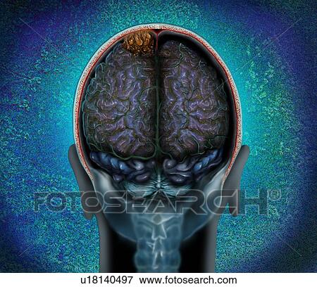 Stock Photo - Brain tumour (brown, top), magnetic resonance imaging (MRI) scan and illustration. This is a convexity meningioma in the parietal lobe of the brain. Meningiomas are cancers of the membranes (meninges) that line the brain. Convexity meningiomas are.... Fotosearch