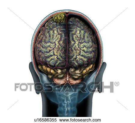 Stock Photography - Brain tumour (yellow, top), magnetic resonance imaging (MRI) scan and illustration. This is a convexity meningioma in the parietal lobe of the brain. Meningiomas are cancers of the membranes (meninges) that line the brain. Convexity meningiomas are.... Fotosearch