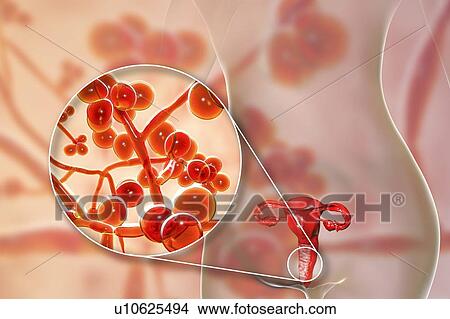 Picture - Candida auris infection in female. Computer illustration showing vaginitis caused by Candida fungi and a close-up view of yeast and hyphae stages of Candida auris. C. auris was first identified in 2009. It causes serious multidrug-resistant infections.... Fotosearch