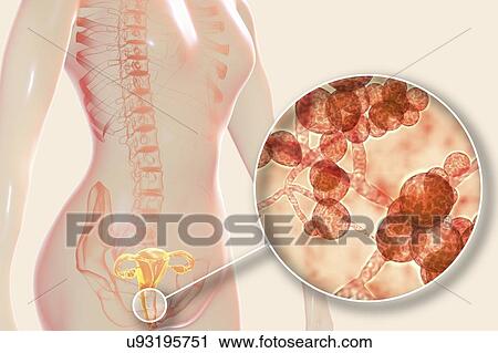 Stock Image - Candida auris infection in female. Computer illustration showing vaginitis caused by Candida fungi and a close-up view of yeast and hyphae stages of Candida auris. C. auris was first identified in 2009. It causes serious multidrug-resistant infections.... Fotosearch