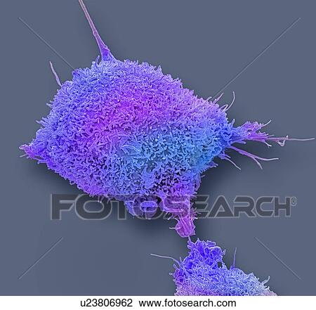 Stock Image - Cervical cancer cell. Coloured scanning electron micrograph (SEM) of a cultured cancer cell (HeLa cells) from a human cervix, showing numerous microvilli (hair-like structures) characteristic of cancer cells. HeLa cells are a continuously cultured.... Fotosearch