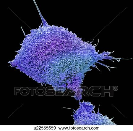 Cervical cancer cell. Coloured scanning electron micrograph (SEM) of a cultured cancer cell (HeLa cells) from a human cervix, showing numerous microvilli (hair-like structures) characteristic of cancer cells. HeLa cells are a continuously cultured... View Large Photo Image Stock Photo - Cervical cancer cell. Coloured scanning electron micrograph (SEM) of a cultured cancer cell (HeLa cells) from a human cervix, showing numerous microvilli (hair-like structures) characteristic of cancer cells. HeLa cells are a continuously cultured.... Fotosearch