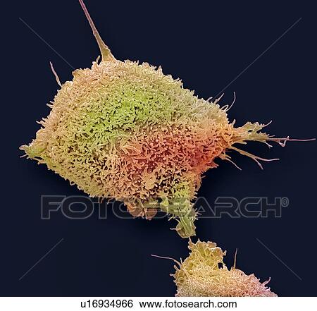 Cervical cancer cell. Coloured scanning electron micrograph (SEM) of a cultured cancer cell (HeLa cells) from a human cervix, showing numerous microvilli (hair-like structures) characteristic of cancer cells. HeLa cells are a continuously cultured... View Large Photo Image Stock Photograph - Cervical cancer cell. Coloured scanning electron micrograph (SEM) of a cultured cancer cell (HeLa cells) from a human cervix, showing numerous microvilli (hair-like structures) characteristic of cancer cells. HeLa cells are a continuously cultured.... Fotosearch