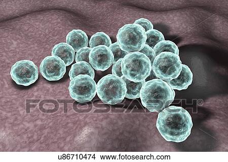 Chlamydia trachomatis bacteria, computer illustration. Chlamydia trachomatis causes a sexually transmitted infection that can go undetected causing infertility. It also causes the eye disease trachoma, which can lead to blindness. View Large Photo Image Picture - Chlamydia trachomatis bacteria, computer illustration. Chlamydia trachomatis causes a sexually transmitted infection that can go undetected causing infertility. It also causes the eye disease trachoma, which can lead to blindness.. Fotosearch