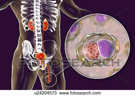 Chlamydial infection. Computer illustration of an urethral smear showing infection with the bacteria Chlamydia trachomatis. Chlamydia survive by infecting host cells and forming inclusion bodies, where they reproduce. New bacteria are released by... View Large Photo Image Stock Image - Chlamydial infection. Computer illustration of an urethral smear showing infection with the bacteria Chlamydia trachomatis. Chlamydia survive by infecting host cells and forming inclusion bodies, where they reproduce. New bacteria are released by.... Fotosearch