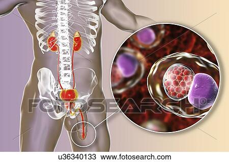 Chlamydial infection. Computer illustration of an urethral smear showing infection with the bacteria Chlamydia trachomatis. Chlamydia survive by infecting host cells and forming inclusion bodies, where they reproduce. New bacteria are released by... View Large Photo Image Stock Image - Chlamydial infection. Computer illustration of an urethral smear showing infection with the bacteria Chlamydia trachomatis. Chlamydia survive by infecting host cells and forming inclusion bodies, where they reproduce. New bacteria are released by.... Fotosearch