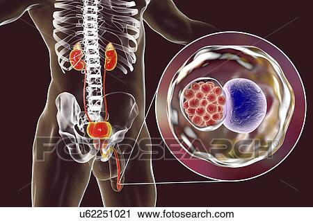 Chlamydial infection. Computer illustration of an urethral smear showing infection with the bacteria Chlamydia trachomatis. Chlamydia survive by infecting host cells and forming inclusion bodies, where they reproduce. New bacteria are released by... View Large Photo Image Stock Image - Chlamydial infection. Computer illustration of an urethral smear showing infection with the bacteria Chlamydia trachomatis. Chlamydia survive by infecting host cells and forming inclusion bodies, where they reproduce. New bacteria are released by.... Fotosearch