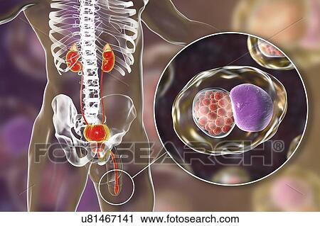 Stock Image - Chlamydial infection. Computer illustration of an urethral smear showing infection with the bacteria Chlamydia trachomatis. Chlamydia survive by infecting host cells and forming inclusion bodies, where they reproduce. New bacteria are released by.... Fotosearch
