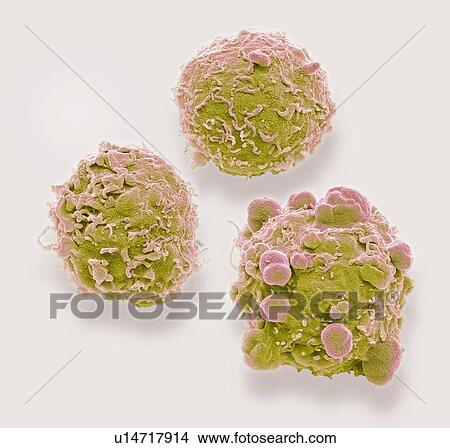 Colorectal cancer cells. Coloured scanning electron micrograph (SEM) of cancer cells from the human colon (large intestine). Cancer of the colon is also known as colorectal cancer. Symptoms include rectal bleeding and abdominal pain. Treatment is with... View Large Photo Image Picture - Colorectal cancer cells. Coloured scanning electron micrograph (SEM) of cancer cells from the human colon (large intestine). Cancer of the colon is also known as colorectal cancer. Symptoms include rectal bleeding and abdominal pain. Treatment is with.... Fotosearch