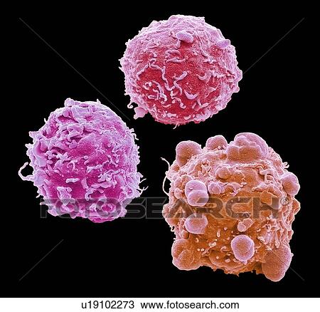 Stock Image - Colorectal cancer cells. Coloured scanning electron micrograph (SEM) of cancer cells from the human colon (large intestine). Cancer of the colon is also known as colorectal cancer. Symptoms include rectal bleeding and abdominal pain. Treatment is with.... Fotosearch
