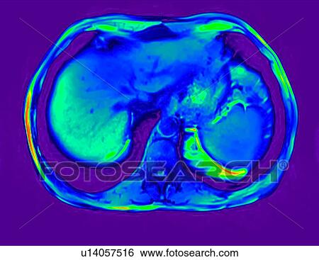 Cross section abdomen I scan of 60 year old male patient with kidney stone View Large Photo Image Stock Photograph - Cross section abdomen I scan of 60 year old male patient with kidney stone. Fotosearch
