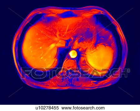 Stock Photography - Cross section abdomen I scan of 60 year old male patient with kidney stone. Fotosearch