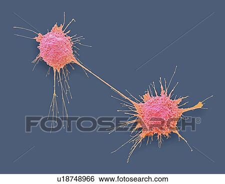 Stock Photograph - Dividing prostate cancer cells, coloured scanning electron micrograph (SEM). Such cells can clump to form tumours, which often invade and destroy surrounding tissues. The prostate is a small gland found in men just below the bladder, surrounding the.... Fotosearch