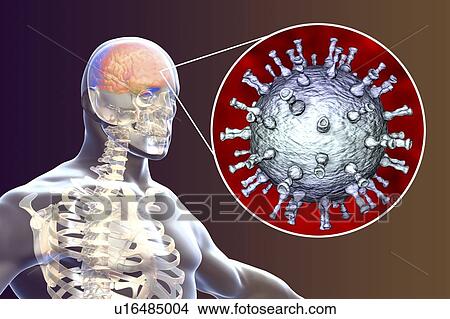 Encephalitis caused by varicella zoster virus (VZV), computer illustration. VZV, a virus from the Herpesviridae family, is the causative agent of chickenpox and shingles. Encephalitis (inflammation of the brain) is one of complications of chickenpox... View Large Photo Image Picture - Encephalitis caused by varicella zoster virus (VZV), computer illustration. VZV, a virus from the Herpesviridae family, is the causative agent of chickenpox and shingles. Encephalitis (inflammation of the brain) is one of complications of chickenpox.... Fotosearch