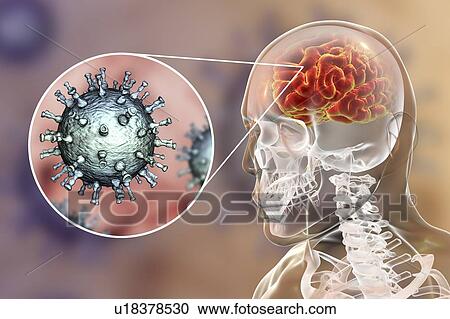 Encephalitis caused by varicella zoster virus (VZV), computer illustration. VZV, a virus from the Herpesviridae family, is the causative agent of chickenpox and shingles. Encephalitis (inflammation of the brain) is one of complications of chickenpox... View Large Photo Image Stock Image - Encephalitis caused by varicella zoster virus (VZV), computer illustration. VZV, a virus from the Herpesviridae family, is the causative agent of chickenpox and shingles. Encephalitis (inflammation of the brain) is one of complications of chickenpox.... Fotosearch