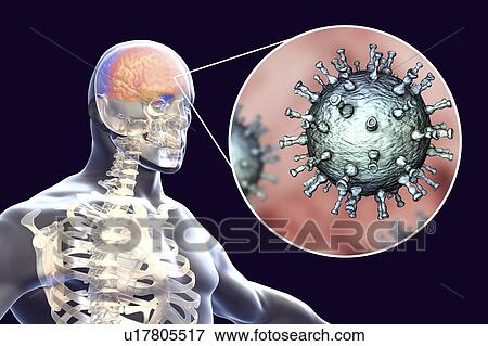 Stock Photo - Encephalitis caused by varicella zoster virus (VZV), computer illustration. VZV, a virus from the Herpesviridae family, is the causative agent of chickenpox and shingles. Encephalitis (inflammation of the brain) is one of complications of chickenpox.... Fotosearch