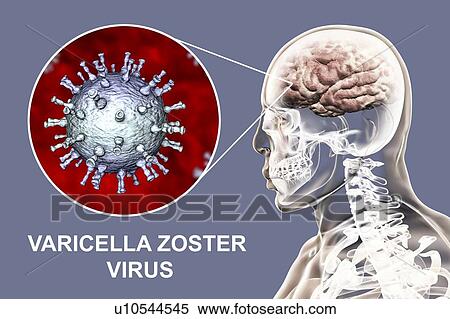 Encephalitis caused by varicella zoster virus (VZV), computer illustration. VZV, a virus from the Herpesviridae family, is the causative agent of chickenpox and shingles. Encephalitis (inflammation of the brain) is one of complications of chickenpox... View Large Photo Image Stock Photography - Encephalitis caused by varicella zoster virus (VZV), computer illustration. VZV, a virus from the Herpesviridae family, is the causative agent of chickenpox and shingles. Encephalitis (inflammation of the brain) is one of complications of chickenpox.... Fotosearch