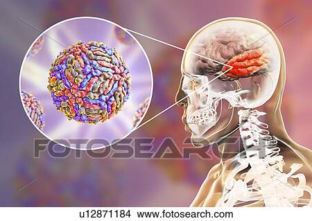 Picture - Encephalitis caused by West Nile virus, computer illustration. West Nile virus (WNV) is known to cause encephalitis (inflammation of the brain) in humans. The WNV belongs to the flavivirus group, which are RNA (ribonucleic acid) viruses that are.... Fotosearch