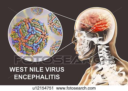 Stock Image - Encephalitis caused by West Nile virus, computer illustration. West Nile virus (WNV) is known to cause encephalitis (inflammation of the brain) in humans. The WNV belongs to the flavivirus group, which are RNA (ribonucleic acid) viruses that are.... Fotosearch