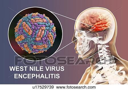 Stock Photo - Encephalitis caused by West Nile virus, computer illustration. West Nile virus (WNV) is known to cause encephalitis (inflammation of the brain) in humans. The WNV belongs to the flavivirus group, which are RNA (ribonucleic acid) viruses that are.... Fotosearch