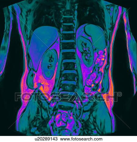 Stock Image - Frontal abdomen I scan of 60 year old male patient with kidney stone. Fotosearch