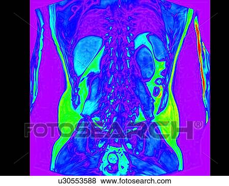 Stock Photo - Frontal abdomen I scan of 60 year old male patient with kidney stone. Fotosearch