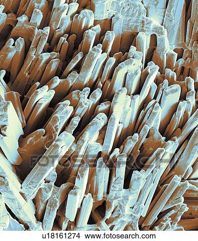 Gallstone crystals. Coloured scanning electron micrograph (SEM) of the crystalline surface of a fractured gallstone. Gallstones form in the gallbladder when there is an imbalance in the chemical composition of the bile. Gallstones mostly consist of... View Large Photo Image Picture - Gallstone crystals. Coloured scanning electron micrograph (SEM) of the crystalline surface of a fractured gallstone. Gallstones form in the gallbladder when there is an imbalance in the chemical composition of the bile. Gallstones mostly consist of.... Fotosearch