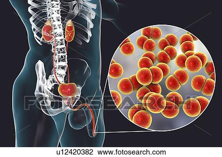 Stock Image - Gonorrhoea infection in male, computer illustration. Gonorrhoea is a sexually transmitted infection caused by Gram-negative bacteria Neisseria gonorrhoeae. In males, N. gonorrhoeae causes urethritis with the main symptoms urethral discharge and a.... Fotosearch