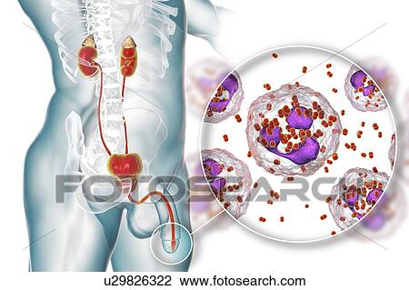 Gonorrhoea infection in male, computer illustration. Gonorrhoea is a sexually transmitted infection caused by Gram-negative bacteria Neisseria gonorrhoeae. In males, N. gonorrhoeae causes urethritis with the main symptoms urethral discharge and a... View Large Photo Image Stock Image - Gonorrhoea infection in male, computer illustration. Gonorrhoea is a sexually transmitted infection caused by Gram-negative bacteria Neisseria gonorrhoeae. In males, N. gonorrhoeae causes urethritis with the main symptoms urethral discharge and a.... Fotosearch