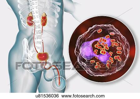 Stock Photograph - Gonorrhoea infection in male, computer illustration. Gonorrhoea is a sexually transmitted infection caused by Gram-negative bacteria Neisseria gonorrhoeae. In males, N. gonorrhoeae causes urethritis with the main symptoms urethral discharge and a.... Fotosearch