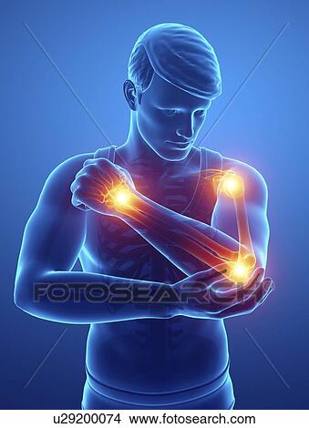 Picture - Man with arm pain, computer illustration.. Fotosearch