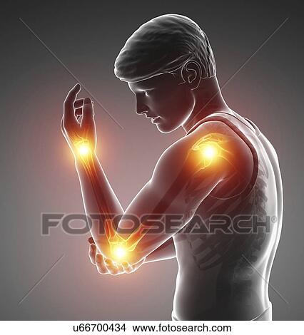 Picture - Man with arm pain, computer illustration.. Fotosearch