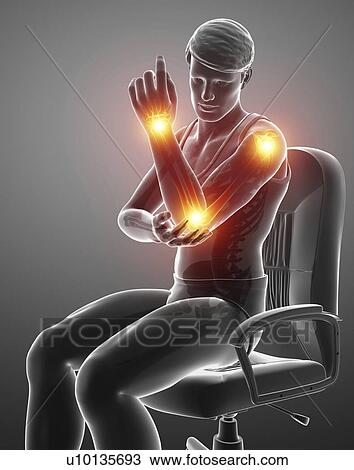 Stock Image - Man with arm pain, computer illustration.. Fotosearch