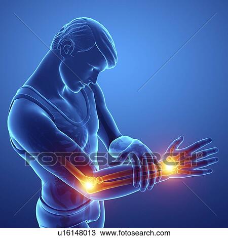 Man with arm pain, computer illustration. View Large Photo Image Stock Image - Man with arm pain, computer illustration.. Fotosearch