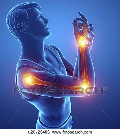 Stock Image - Man with arm pain, computer illustration.. Fotosearch