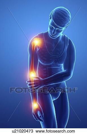 Stock Image - Man with arm pain, computer illustration.. Fotosearch