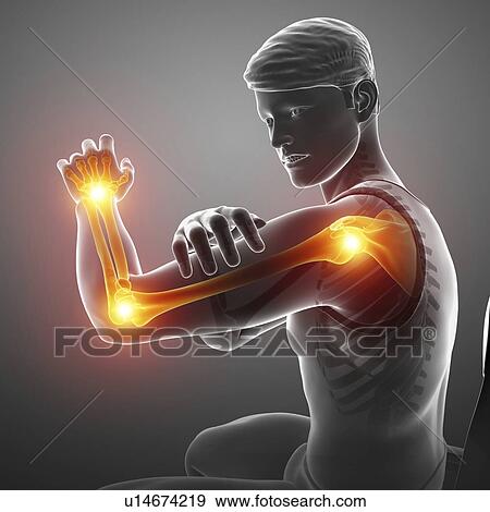 Stock Photo - Man with arm pain, computer illustration.. Fotosearch