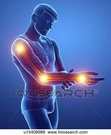 Stock Photo - Man with arm pain, computer illustration.. Fotosearch